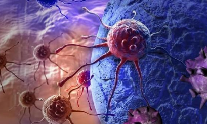 胃彌漫大B細胞淋巴瘤合并印戒細胞癌案例