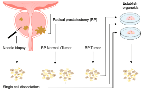 SXR20220101048C+人類原發性前列腺癌的單細胞分析揭示了腫瘤相關上皮細胞狀態的異質性